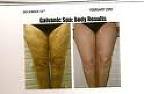 Cellulite treatment #01