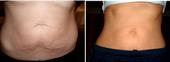 Cellulite & Toning Treatment. stomach